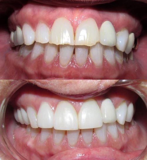 Veneers Encinitas, California Dr. John Maroon, DDS